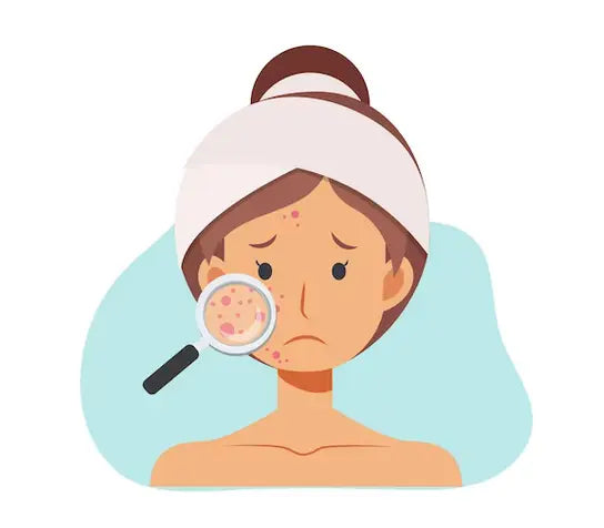 what are homemade remedies for treating acne using ayurvedic or herbal products? Nutrixia Food